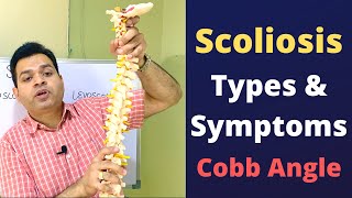 Scoliosis Types of Scoliosis Cobb Angle Scoliosis Treatment Scoliosis Symptoms [upl. by Fabe]