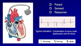 Pacemaker Modes and Settings [upl. by Nossyla]