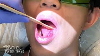 Grade 4 severe TongueTie  Pre Procedure and Post Op Comments  The Breathe Institute [upl. by Nikita]