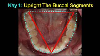 Invisalign aligners IZC screws Attachments and IPR [upl. by Lsiel204]