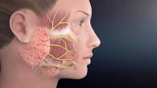 Parotid Surgery Animation  Overview of Minimally Invasive Parotidectomy [upl. by Andy]