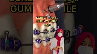 SCREW🔩ഇട്ട് ശരിയാക്കിത്തരും👍🏻dentist gummysmile braces youtubeshorts malayalam treatment [upl. by Jarita689]