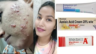 RetinoA Cream Adhphlen gel 01 Azelic Acid cream Remove AcneScarsMarks  मुंहासे और गढ्ढे [upl. by Adnohser]