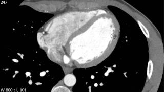 Left Ventricle Anatomy on Axial Cardiac CT [upl. by Eidnar]