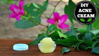 DIY Acne amp Acne Scar Removal Cream That Really Works CLINICALLY PROVEN [upl. by Otreblada]