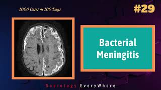 Bacterial Meningitis Radiology Video  1000 cases in 100 days  Video 29  CNS infections [upl. by Eveineg]