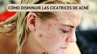 Cómo Disminuir las Cicatrices de Acné con Remedios Naturales [upl. by Mari]