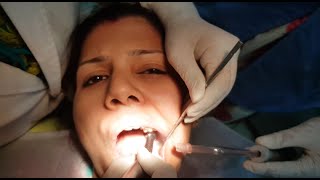 Dental Drilling  Root Canal  Dent Economy  Dentist  Dental [upl. by Yecnay]