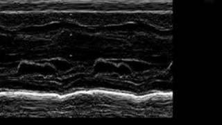 Asymmetric Septal Hypertrophy ASH in an Infant [upl. by Airbmac397]