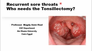 Recurrent sore throats Who needs the Tonsillectomy [upl. by Valerian]