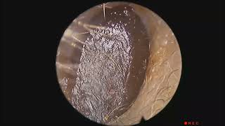 Instant Cleaning Of Formed And Obstructive Earwax [upl. by Atteynad]