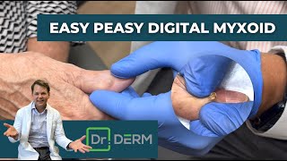 Easy Peasy Digital Myxoid  Dr Derm [upl. by Adnor]