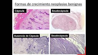 10 Neoplasias 1B Pato Anato Neoplasias Benignas vs Malignas 1 [upl. by Crista]