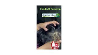 Dandruff Removal  Scratching a Patch of Dandruff Flaky Scalp  itchy scalp ASMAR Scalp care [upl. by Notled]