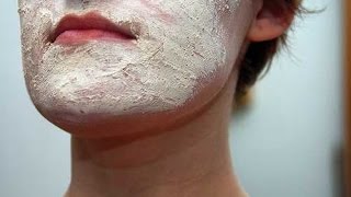 Face Eczema  Atopic Dermatitis  Eczema Dermatitis Rash Treatment [upl. by Kablesh]