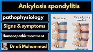 Ankylosis spondylitis and homeopathy Dr Ali Muhammad [upl. by Atcele]