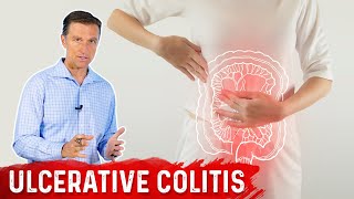 What is Ulcerative Colitis – Causes Symptoms amp Treatment by DrBerg [upl. by Sanoy]