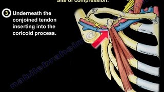 Thoracic Outlet Syndrome  Everything You Need To Know  Dr Nabil Ebraheim [upl. by Felicity249]