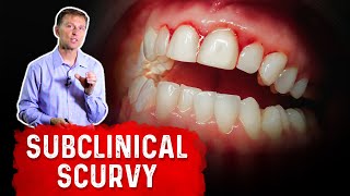 Vitamin C Deficiency Subclinical Scurvy – Causes Symptoms and Remedies – Dr Berg [upl. by Scarrow]