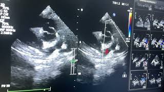 Complete AV Septal defect Double outlet RV severe Pulmonary stenosis Glen shunt [upl. by Sheedy]