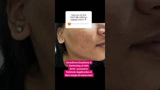 Tretinoin cream side effects  Acneiform Eruptions  Pigmentation of skin  Dr Ashima Goel MD [upl. by Alyda450]