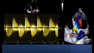 Color doppler is not enough to assess Severity of aortic Regurgitation [upl. by Rocker]