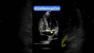 Coronary Sinus on Echocardiography echocardiogram cardiology echo [upl. by Analim]