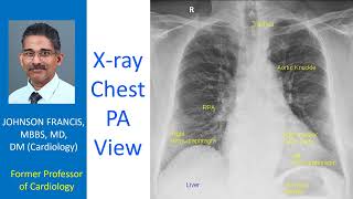 X ray Chest PA View CXR PA [upl. by Animlehliw]