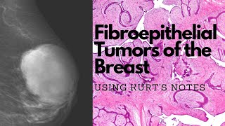 Fibroadenomas and Phyllodes Tumor of the Breast Using Kurt’s Notes pathagonia [upl. by Alisun800]