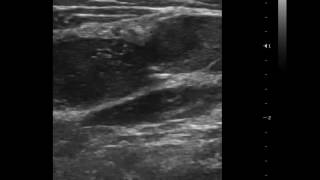 CASE 214 TB cervical lymphadenitis [upl. by Noma]