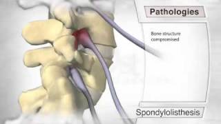 Spondylolisthesis Pathology [upl. by Kcod]