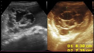 Chronic Liver Disease  Ovarian cyst Peritoneal inclusion cyst [upl. by Enihpets]