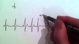 A Cardiologist explains Atrial Ectopic beats with an ECG annotation [upl. by Asssilem]