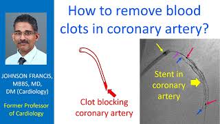 How to remove blood clots in coronary artery [upl. by Koral]