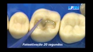 RESTAURAÇÃO RESINA COMPOSTA CLASSE I ACOES INTEGRADAS DENTISTICA [upl. by Lavud]