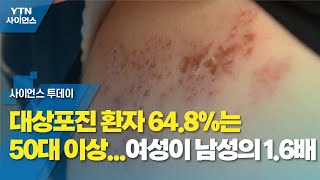 대상포진 환자 648는 50대 이상여성이 남성의 16배  YTN 사이언스 [upl. by Botsford63]