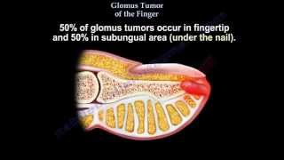 Glomus Tumor Of The Finger  Everything You Need To Know  Dr Nabil Ebraheim [upl. by Steddman]