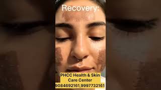 CO2quot Laser Acne scars Treatment acnetreatment pimples hydrafacial trendingreelsvideo new [upl. by Katleen]