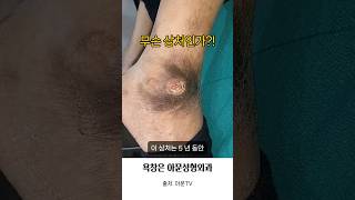 무슨 상처 인가 발목 욕창 소독 치료 병원 성형외과 ankle bedsore pressure sore dressing seoul korea아문TV [upl. by Weinstock]