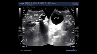 Ultrasound Video showing the Differentiation between Simple Hepatic Cyst and Hydatid Cyst [upl. by Leslie]