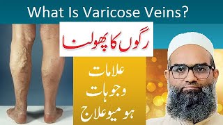 Varicose Veins  Part 1  Causes Symptoms and Homeopathic treatment  Shahbaz Qamar [upl. by Arded694]