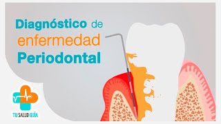 Diagnóstico de enfermedad periodontal  Tu Salud Guía [upl. by Adiehsar109]