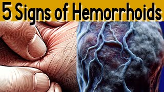 5 signs and symptoms of Hemorrhoids and treatment [upl. by Yemrots]