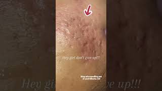 Effective method for removing deep acne scars [upl. by Auqenaj]