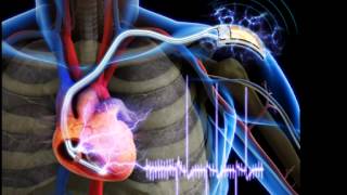 Selfpowered Cardiac Pacemaker avoids additional surgeries [upl. by Akelam552]