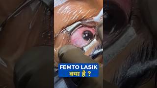 What Is FEMTO Lasik [upl. by Adnirod]