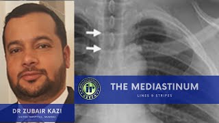 TMT Lines amp Stripes on Xray Chest by Dr Zubair Kazi [upl. by Hutner]