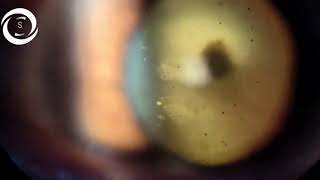 Ophthalmic Signs Anterior Segment [upl. by Trant]