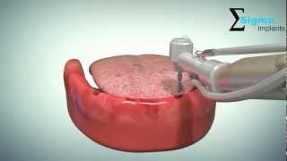 Implant supported overdenture rehabilitation [upl. by Eenobe362]