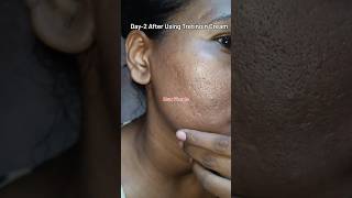 Day2 After Using Tretinoin Cream 0025 skincare viralvideo youtubeshorts shorts tretinoin [upl. by Oibaf325]